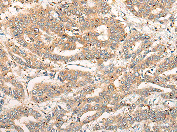 Immunohistochemistry of paraffin-embedded Human liver cancer tissue using CPNE4 Polyclonal Antibody at dilution of 1:40(×200)