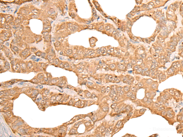 Immunohistochemistry of paraffin-embedded Human thyroid cancer tissue using CUTA Polyclonal Antibody at dilution of 1:45(×200)