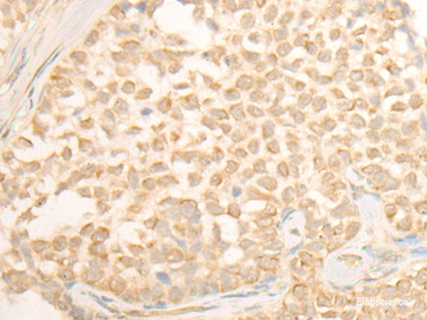 Immunohistochemistry of paraffin-embedded Human ovarian cancer tissue using CYP4X1 Polyclonal Antibody at dilution of 1:40(×200)