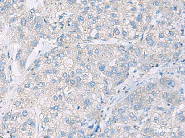 Immunohistochemistry of paraffin-embedded Human liver cancer tissue using DACT3 Polyclonal Antibody at dilution of 1:55(×200)
