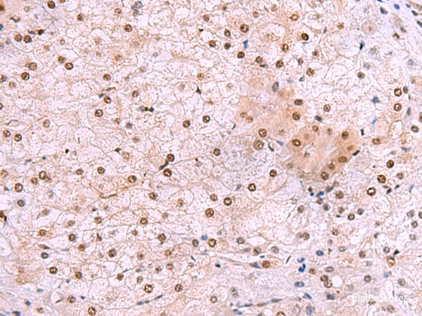Immunohistochemistry of paraffin-embedded Human liver cancer tissue using DDI2 Polyclonal Antibody at dilution of 1:50(×200)