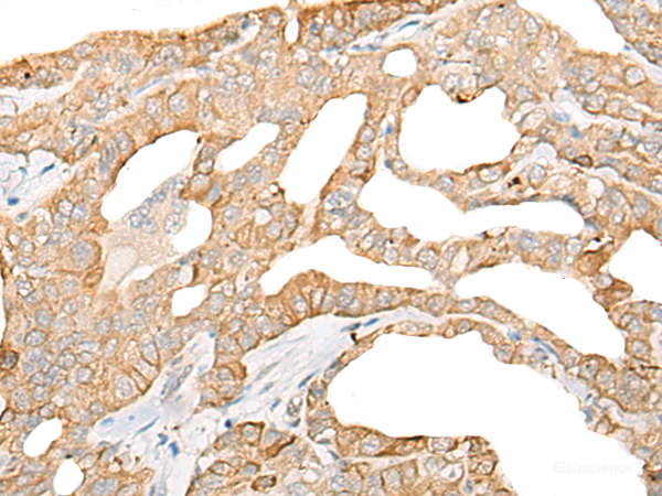 Immunohistochemistry of paraffin-embedded Human thyroid cancer tissue using DDX24 Polyclonal Antibody at dilution of 1:35(×200)