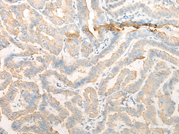 Immunohistochemistry of paraffin-embedded Human thyroid cancer tissue using CELA3A Polyclonal Antibody at dilution of 1:25(×200)