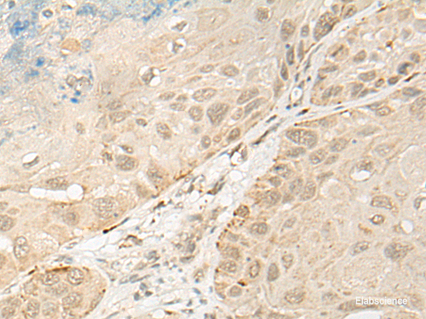 Immunohistochemistry of paraffin-embedded Human esophagus cancer tissue using OTX1 Polyclonal Antibody at dilution of 1:30(×200)