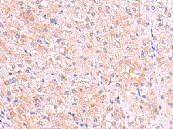 Immunohistochemistry of paraffin-embedded Human liver cancer tissue using PISD Polyclonal Antibody at dilution of 1:80(×200)