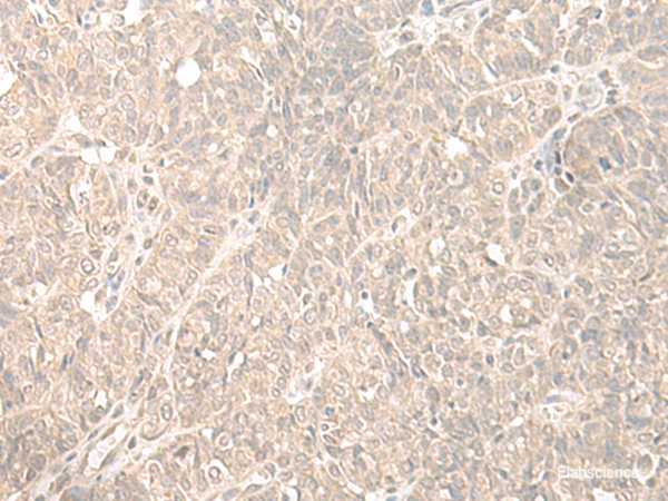 Immunohistochemistry of paraffin-embedded Human ovarian cancer tissue using HENMT1 Polyclonal Antibody at dilution of 1:35(×200)