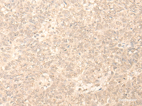 Immunohistochemistry of paraffin-embedded Human ovarian cancer tissue using PLEKHA1 Polyclonal Antibody at dilution of 1:30(×200)