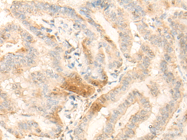 Immunohistochemistry of paraffin-embedded Human thyroid cancer tissue using BZW2 Polyclonal Antibody at dilution of 1:25(×200)