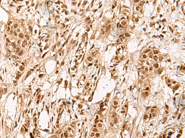 Immunohistochemistry of paraffin-embedded Human breast cancer tissue using ZBTB43 Polyclonal Antibody at dilution of 1:90(×200)
