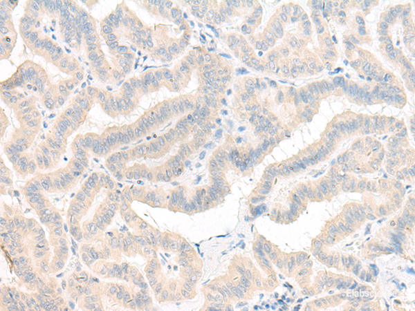 Immunohistochemistry of paraffin-embedded Human thyroid cancer tissue using AOAH Polyclonal Antibody at dilution of 1:25(×200)