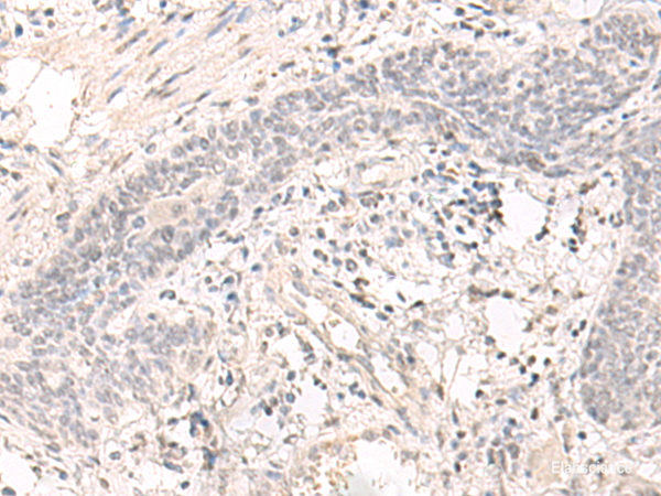 Immunohistochemistry of paraffin-embedded Human esophagus cancer tissue using SAP130 Polyclonal Antibody at dilution of 1:35(×200)
