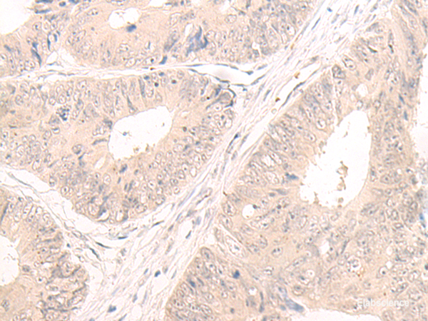 Immunohistochemistry of paraffin-embedded Human colorectal cancer tissue using LCMT2 Polyclonal Antibody at dilution of 1:55(×200)