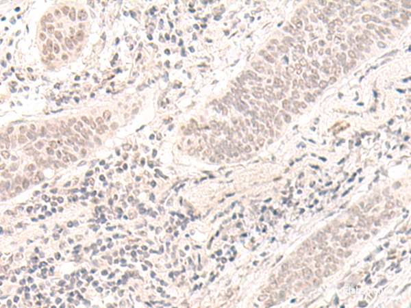 Immunohistochemistry of paraffin-embedded Human esophagus cancer tissue using ZBED1 Polyclonal Antibody at dilution of 1:40(×200)