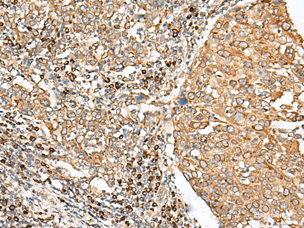 Immunohistochemistry of paraffin-embedded Human cervical cancer tissue using STT3A Polyclonal Antibody at dilution of 1:70(×200)