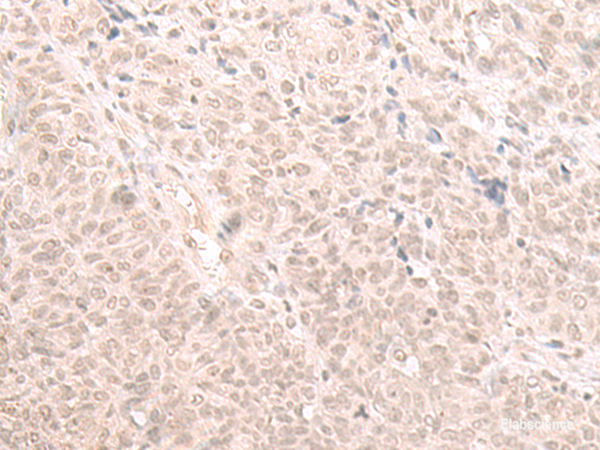 Immunohistochemistry of paraffin-embedded Human ovarian cancer tissue using HOOK2 Polyclonal Antibody at dilution of 1:30(×200)