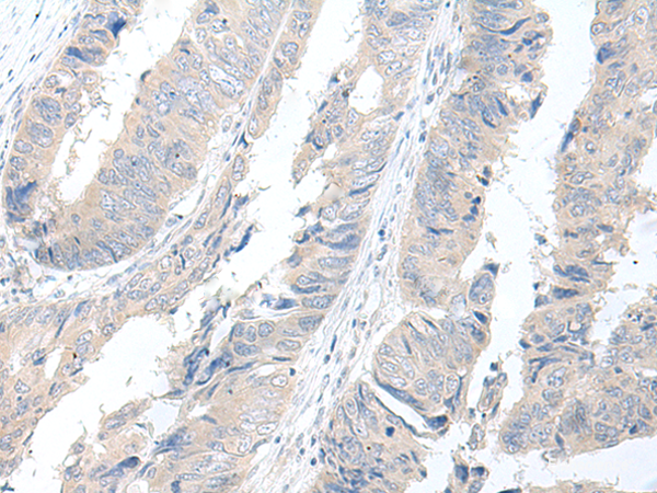 Immunohistochemistry of paraffin-embedded Human colorectal cancer tissue using GBA2 Polyclonal Antibody at dilution of 1:55(×200)
