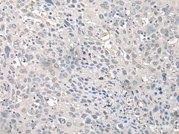 Immunohistochemistry of paraffin-embedded Human cervical cancer tissue using EPM2A Polyclonal Antibody at dilution of 1:75(×200)
