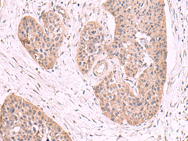 Immunohistochemistry of paraffin-embedded Human esophagus cancer tissue using MGP Polyclonal Antibody at dilution of 1:50(×200)