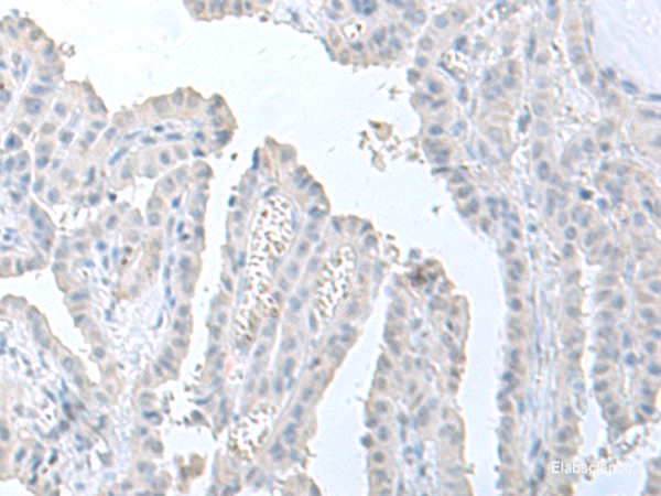 Immunohistochemistry of paraffin-embedded Human thyroid cancer tissue using STAU2 Polyclonal Antibody at dilution of 1:60(×200)
