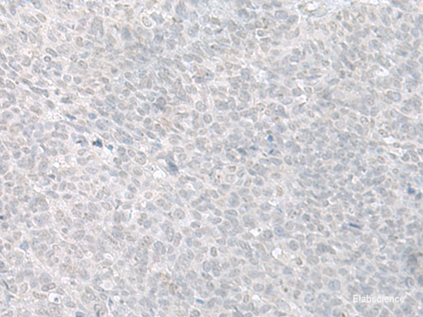 Immunohistochemistry of paraffin-embedded Human ovarian cancer tissue using C8orf4 Polyclonal Antibody at dilution of 1:70(×200)