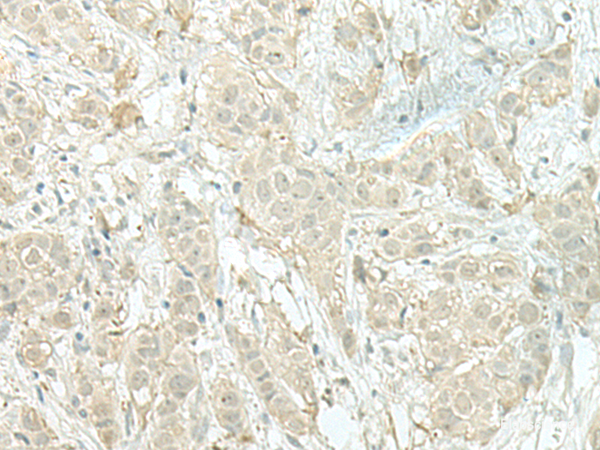 Immunohistochemistry of paraffin-embedded Human breast cancer tissue using MIEN1 Polyclonal Antibody at dilution of 1:100(×200)