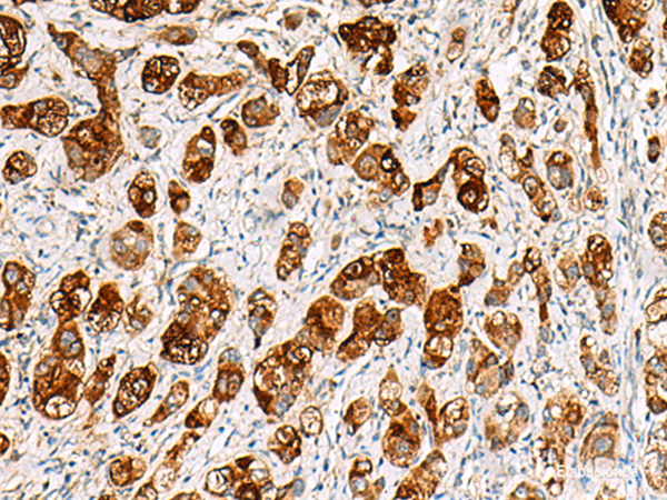 Immunohistochemistry of paraffin-embedded Human liver cancer tissue using SAA1 Polyclonal Antibody at dilution of 1:70(×200)