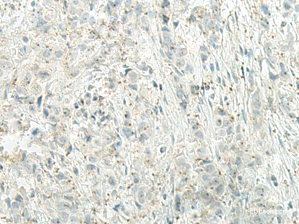 Immunohistochemistry of paraffin-embedded Human breast cancer tissue using UQCC2 Polyclonal Antibody at dilution of 1:60(×200)