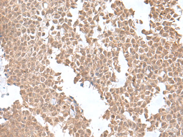 Immunohistochemistry of paraffin-embedded Human ovarian cancer tissue using SNRNP25 Polyclonal Antibody at dilution of 1:55(×200)