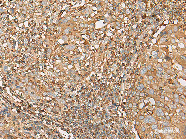 Immunohistochemistry of paraffin-embedded Human cervical cancer tissue using UBE2A Polyclonal Antibody at dilution of 1:55(×200)