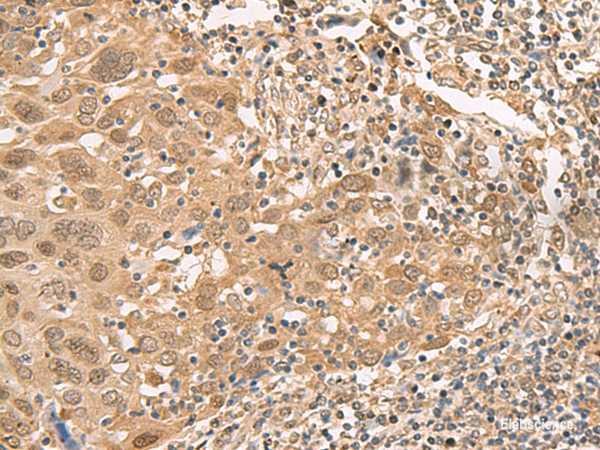 Immunohistochemistry of paraffin-embedded Human cervical cancer tissue using ISCU Polyclonal Antibody at dilution of 1:45(×200)