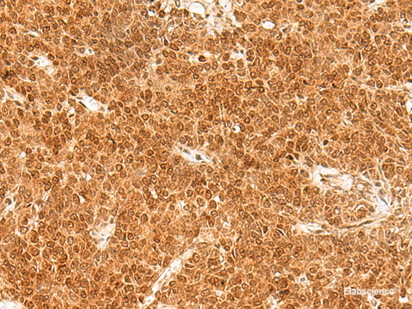 Immunohistochemistry of paraffin-embedded Human ovarian cancer tissue using TOR1A Polyclonal Antibody at dilution of 1:30(×200)