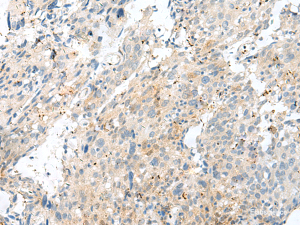 Immunohistochemistry of paraffin-embedded Human cervical cancer tissue using NXNL1 Polyclonal Antibody at dilution of 1:45(×200)
