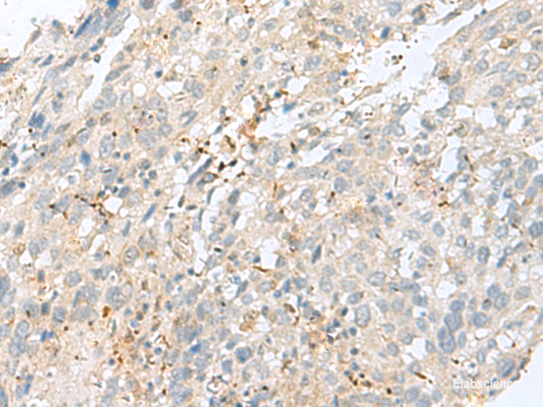 Immunohistochemistry of paraffin-embedded Human cervical cancer tissue using TPMT Polyclonal Antibody at dilution of 1:60(×200)