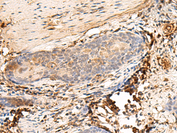 Immunohistochemistry of paraffin-embedded Human esophagus cancer tissue using HLA-DQB1 Polyclonal Antibody at dilution of 1:30(×200)