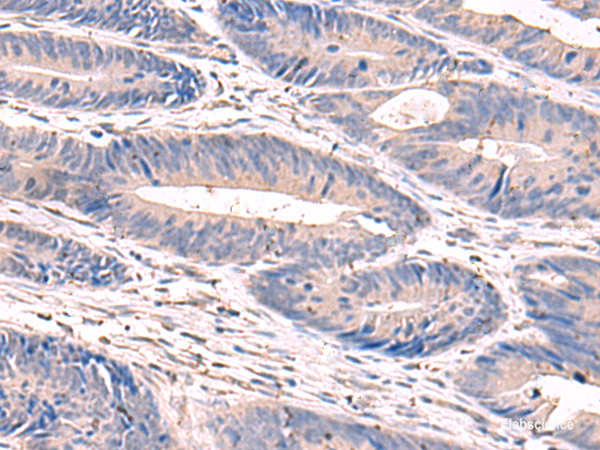 Immunohistochemistry of paraffin-embedded Human colorectal cancer tissue using GKAP1 Polyclonal Antibody at dilution of 1:100(×200)