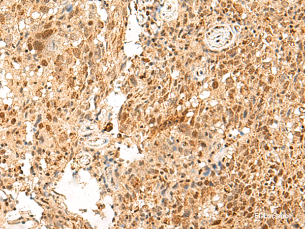 Immunohistochemistry of paraffin-embedded Human cervical cancer tissue using PAF1 Polyclonal Antibody at dilution of 1:55(×200)