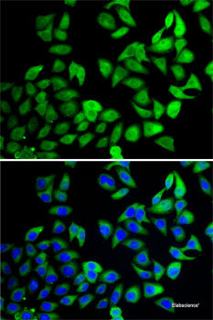 Immunohistochemistry of paraffin-embedded Human liver cancer using CDC16 Polyclonal Antibody at dilution of 1:100 (40x lens).