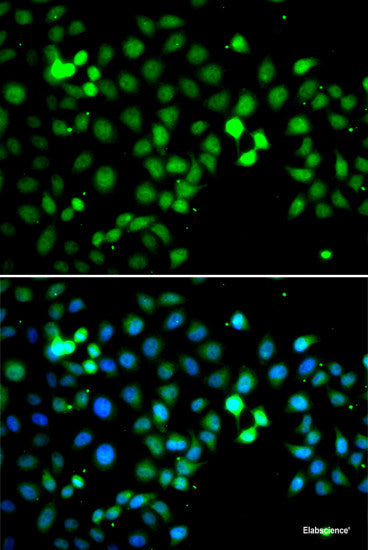 Immunohistochemistry of paraffin-embedded Human liver cancer using BLVRB Polyclonal Antibody at dilution of 1:100 (40x lens).