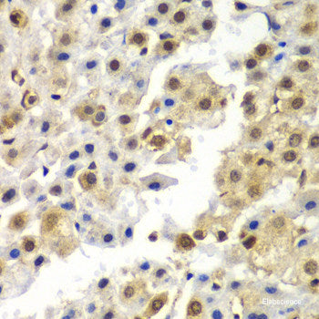 Immunohistochemistry of paraffin-embedded Human liver cancer using NAA60 Polyclonal Antibody at dilution of 1:200 (40x lens).