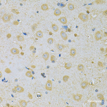 Immunohistochemistry of paraffin-embedded Human lung cancer using SH3GLB2 Polyclonal Antibody at dilution of 1:200 (40x lens).