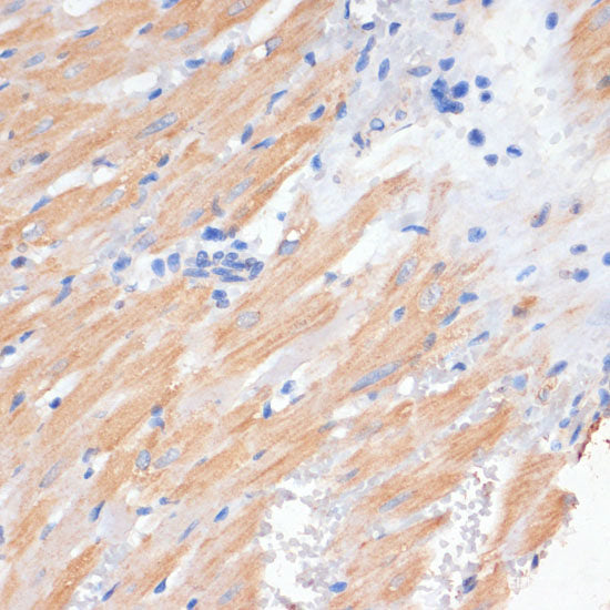 Immunohistochemistry of paraffin-embedded Human liver cancer using GLUD1 Polyclonal Antibody at dilution of 1:100 (40x lens).