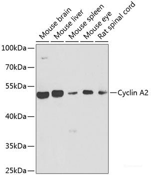 Immunohistochemistry of paraffin-embedded Human gastric cancer using ECSIT Polyclonal Antibody at dilution of 1:100 (40x lens).
