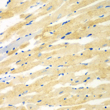 Immunohistochemistry of paraffin-embedded Human brain cancer using PIK3R3 Polyclonal Antibody at dilution of 1:100 (40x lens).