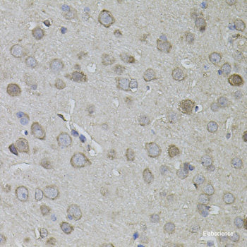 Immunohistochemistry of paraffin-embedded Human breast cancer using HDAC4 Polyclonal Antibody at dilution of 1:100 (40x lens).