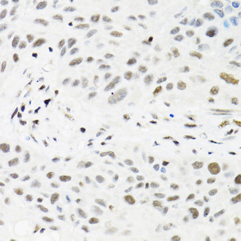 Immunohistochemistry of paraffin-embedded Human colon carcinoma using CEBPG Polyclonal Antibody at dilution of 1:100 (40x lens).