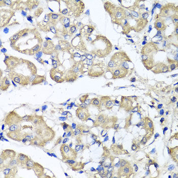 Immunohistochemistry of paraffin-embedded Human liver damage using AARS2 Polyclonal Antibody at dilution of 1:100 (40x lens).
