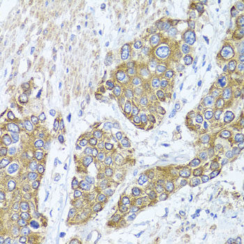 Immunohistochemistry of paraffin-embedded Human brain cancer using WIPI1 Polyclonal Antibody at dilution of 1:100 (40x lens).