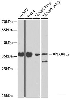 Immunohistochemistry of paraffin-embedded Human brain cancer using PAK6 Polyclonal Antibody at dilution of 1:100 (40x lens).