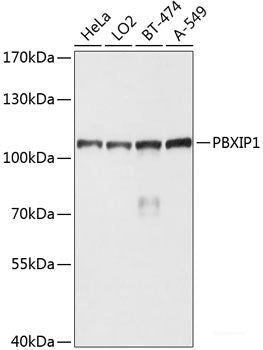 Immunohistochemistry of paraffin-embedded Human liver damage using SLC2A2 Polyclonal Antibody at dilution of 1:100 (40x lens).