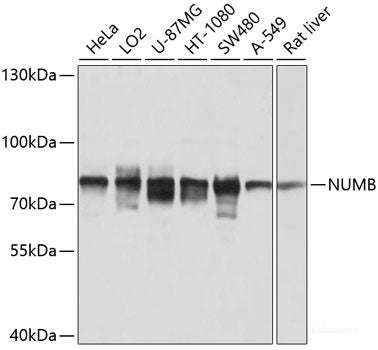 Immunohistochemistry of paraffin-embedded Human liver cancer using RRAGD Polyclonal Antibody at dilution of 1:100 (40x lens).